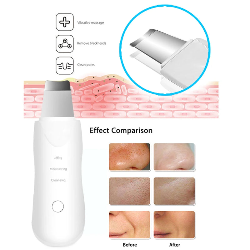 Aparelho de Limpeza Facial -  Vibratório, Massageador, Removedor de Acne e Cravos e Peeling